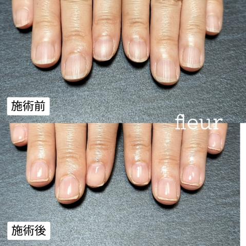 自爪育成